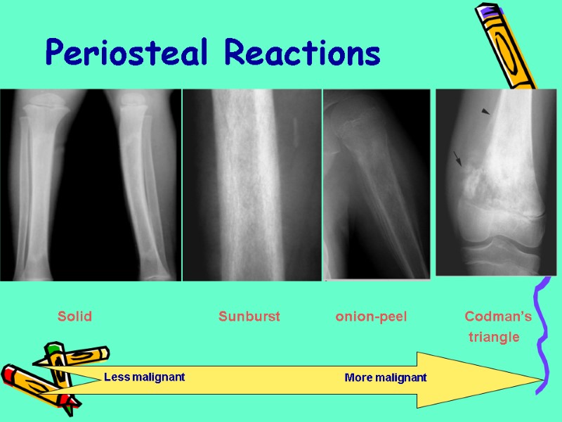 Periosteal Reactions Solid onion-peel Sunburst Codman’s  triangle